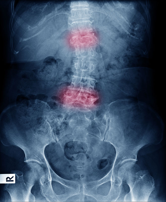 Ankylosing Spondylitis Imaging X-ray image front view of lumbar spines show deformity and compression fracture at red area mark and Scoliosis , ankylosing spondylitis