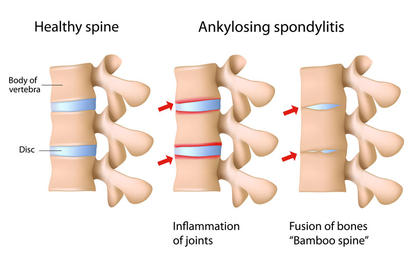 Ankylosing spondylitis of the spine Ankylosing spondylitis of the spine