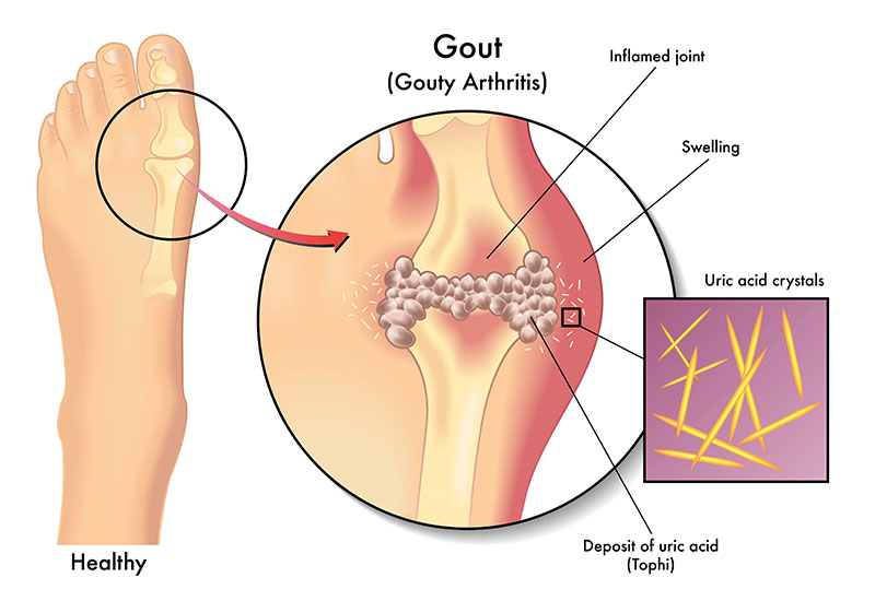 Diagram of Gout in toe joint Diagram of Gout in toe joint