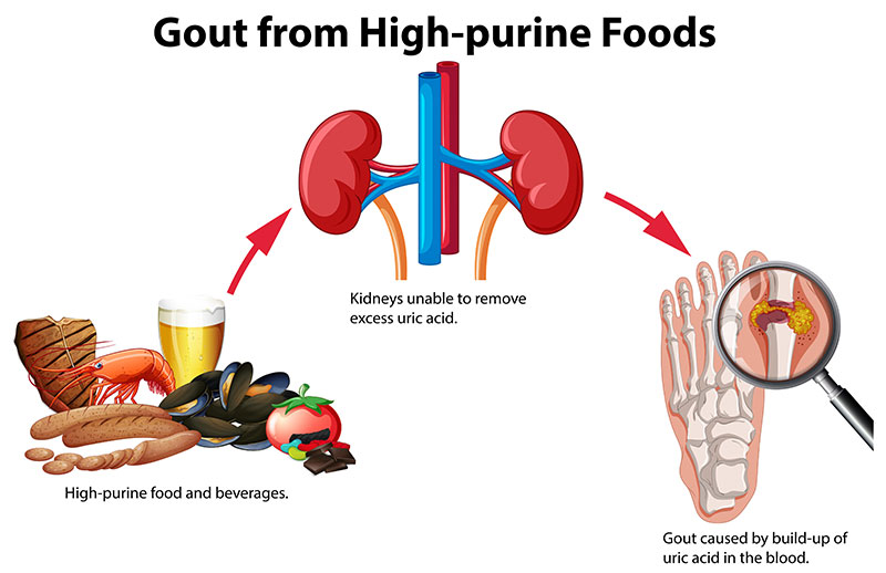 Transitional chart showing high-purine foods unable to be filtered by kidneys, leading to gout
