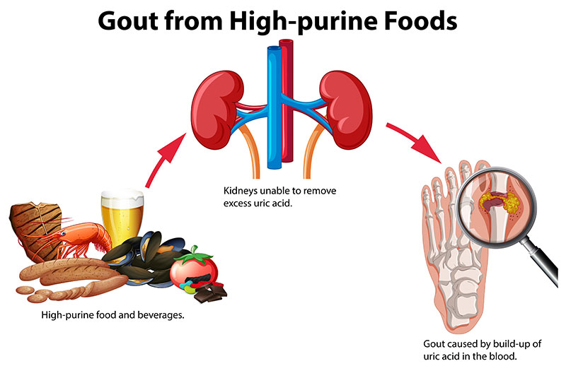 Gout from High-Purine Foods Transitional chart showing high-purine foods unable to be filtered by kidneys, leading to gout
