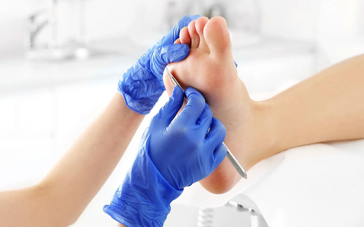 Corns and Calluses