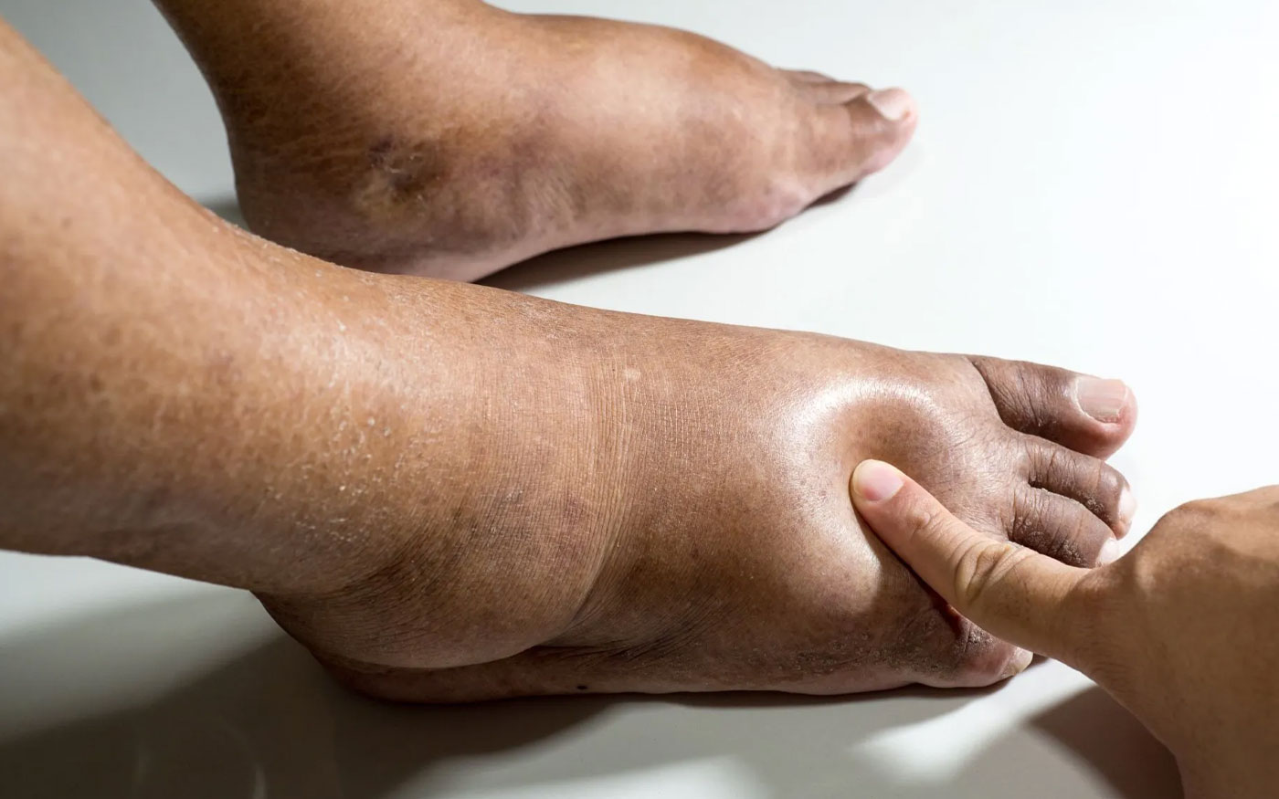 Diabetes and Your Feet