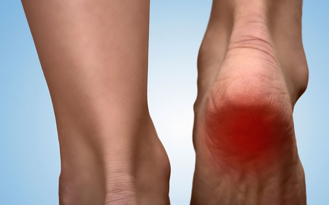 Heel Spurs