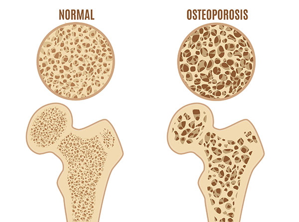 normal bone and osteoporosis bone diagram of normal bone and osteoporosis bone