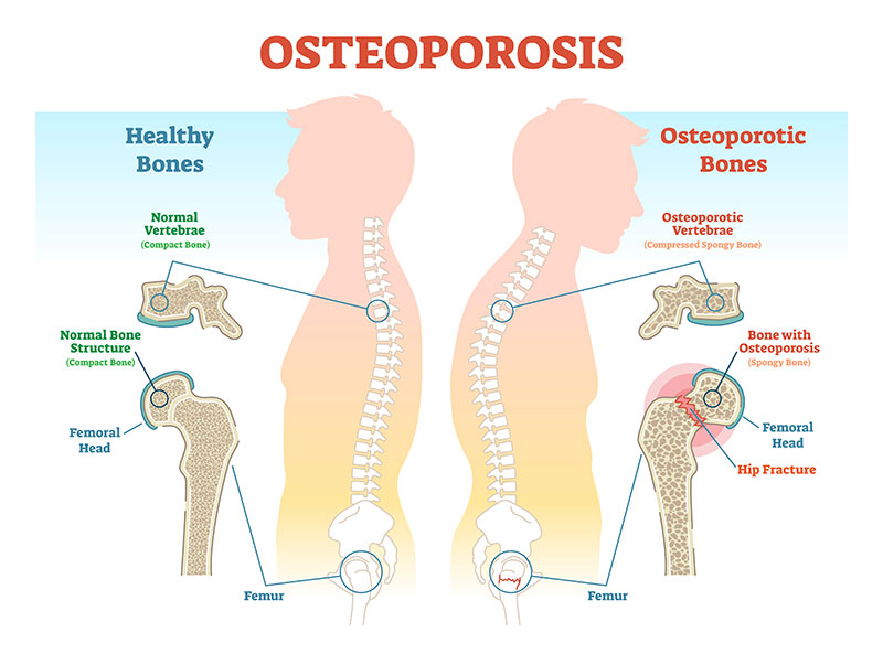 osteoporosis
