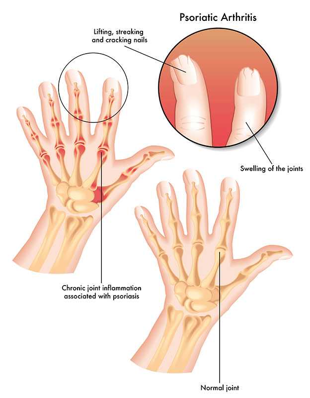 Symptoms of Psoriatic Arthritis Symptoms of Psoriatic Arthritis